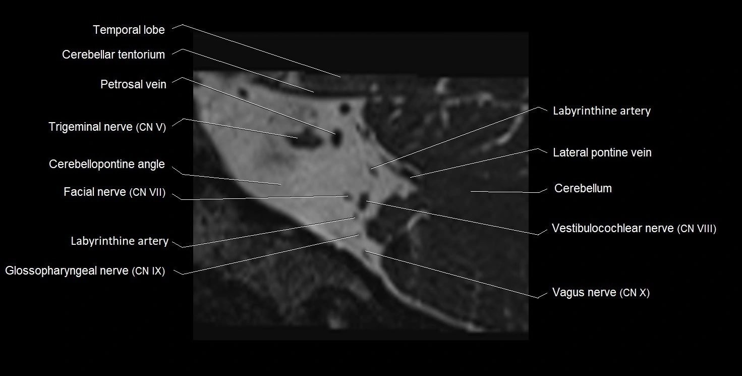Internal auditory meatus (IAM) 3T sagittal cross sectional anatomy image 37.webp